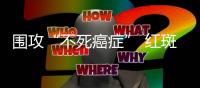 围攻“不死癌症” 红斑狼疮
